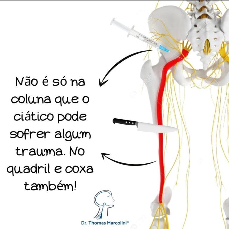 Injeção no nervo ciático Nervo ciático lesionado no glúteo