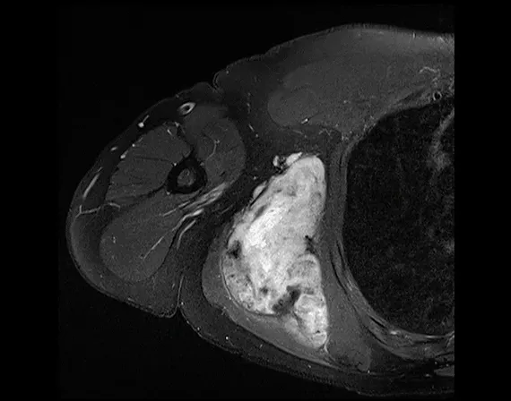 Médico para schwannoma de nervos periféricos em SP Médico para tumores da bainha dos nervos periféricos que atua em são paulo capital.