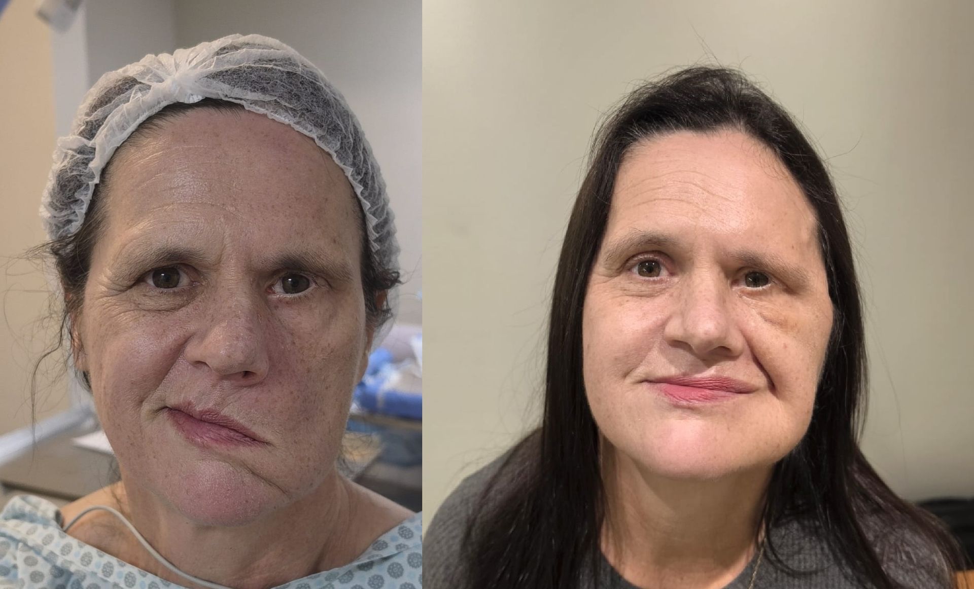 Sequelas de paralisia facial antes e depois: cirurgia de transferência do músculo masseter para reanimação do sorriso