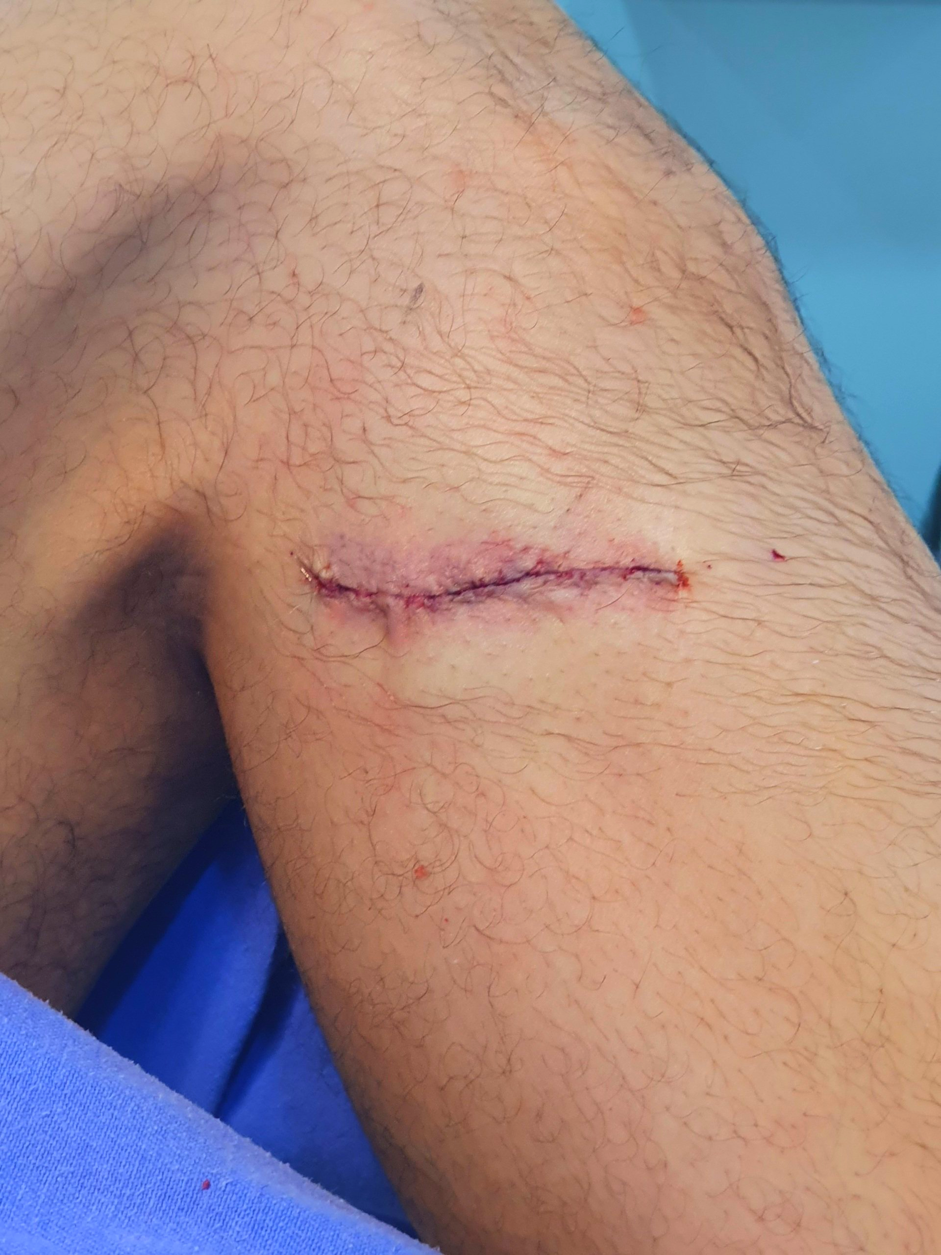 Quais são os sintomas da Neuropatia do nervo fibular? Perda da dorsiflexão do pé. Quais são os sintomas da Compressão do nervo fibular?