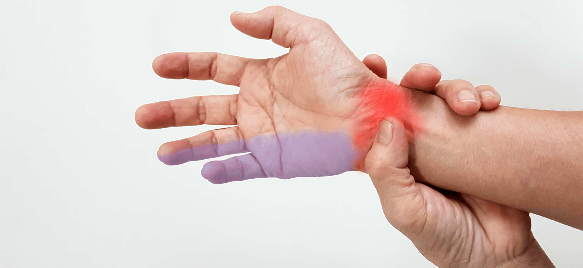 Mãos mostrando os dedos mindinho e anelar destacados em roxo e o punho em vermelho, dedos que formigam na compressão do nervo ulnar