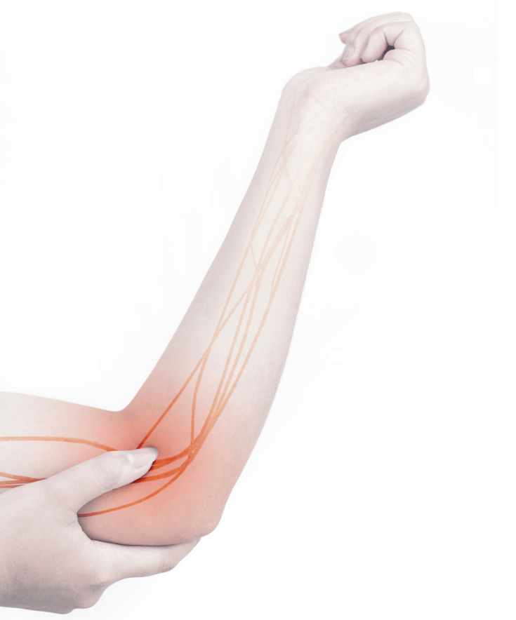 Ilustração do braço com o nervo ulnar destacado em vermelho na região do cotovelo, mostrando a compressão do nervo ulnar