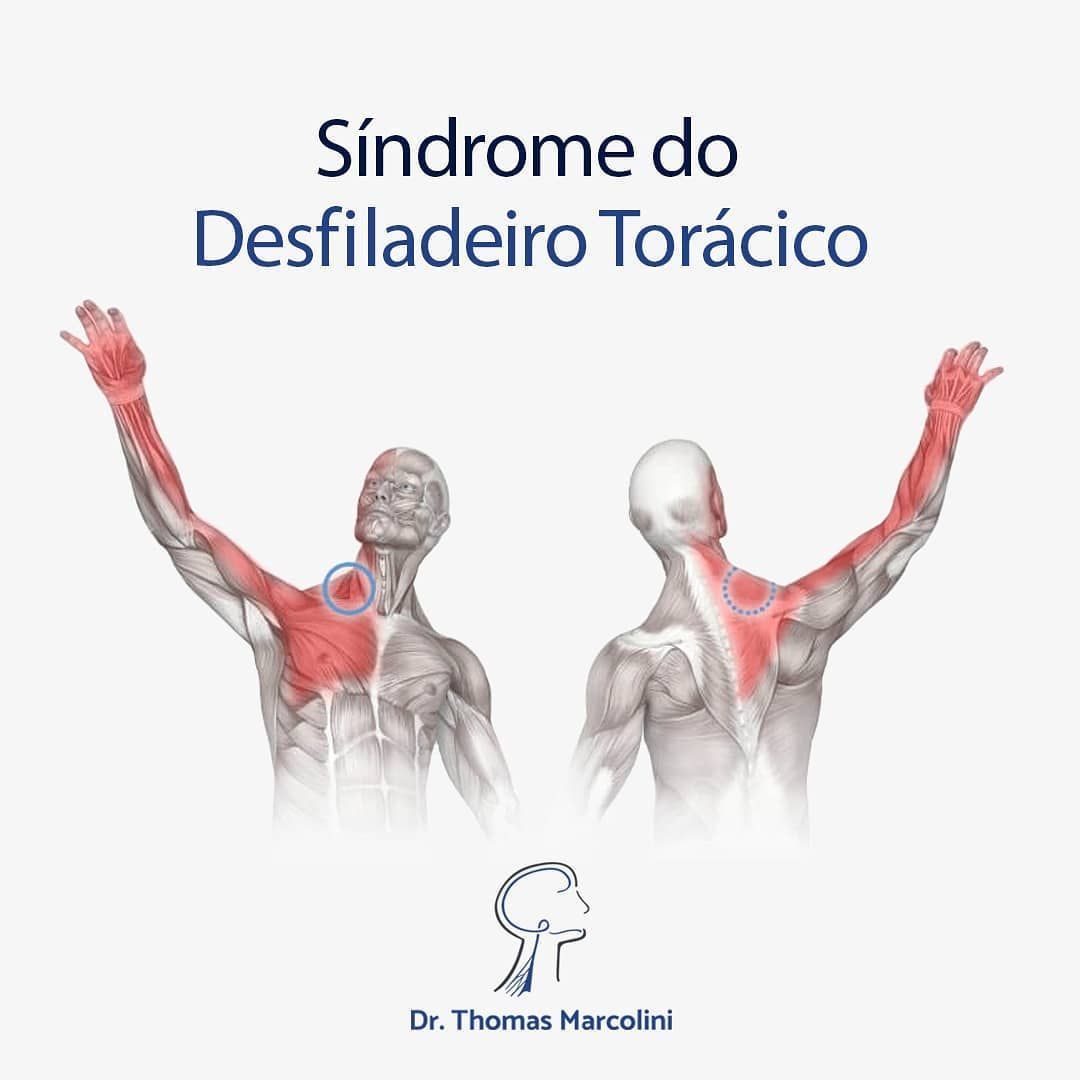 Quem trata a síndrome do desfiladeiro torácico. Médico para síndrome do desfiladeiro torácico.