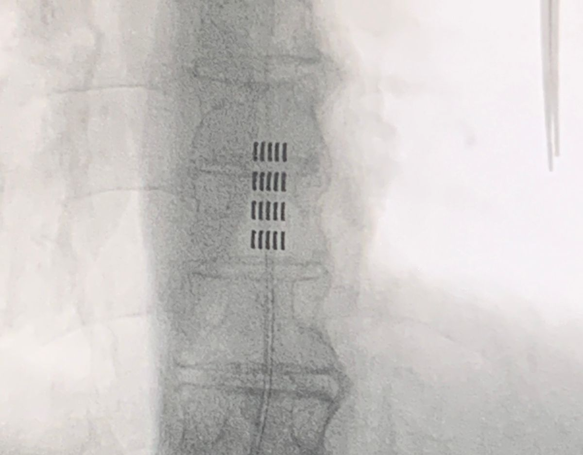 Raio-x mostrando eletrodo de estimulação medular (SCS) implantado na coluna para tratamento da dor crônica