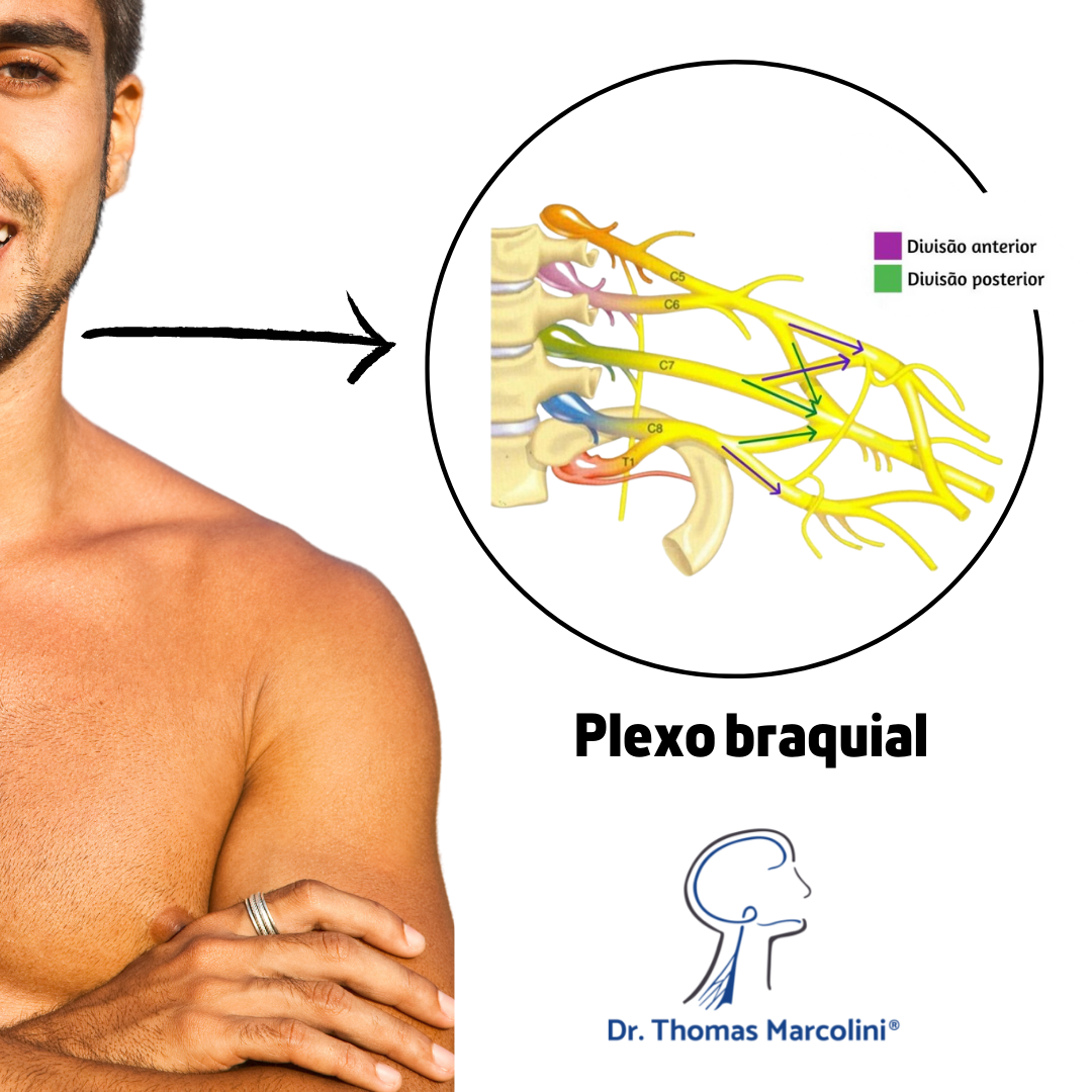 Ombro de um homem com seta apontando para ilustração ampliada dos nervos do plexo braquial saindo da coluna cervical