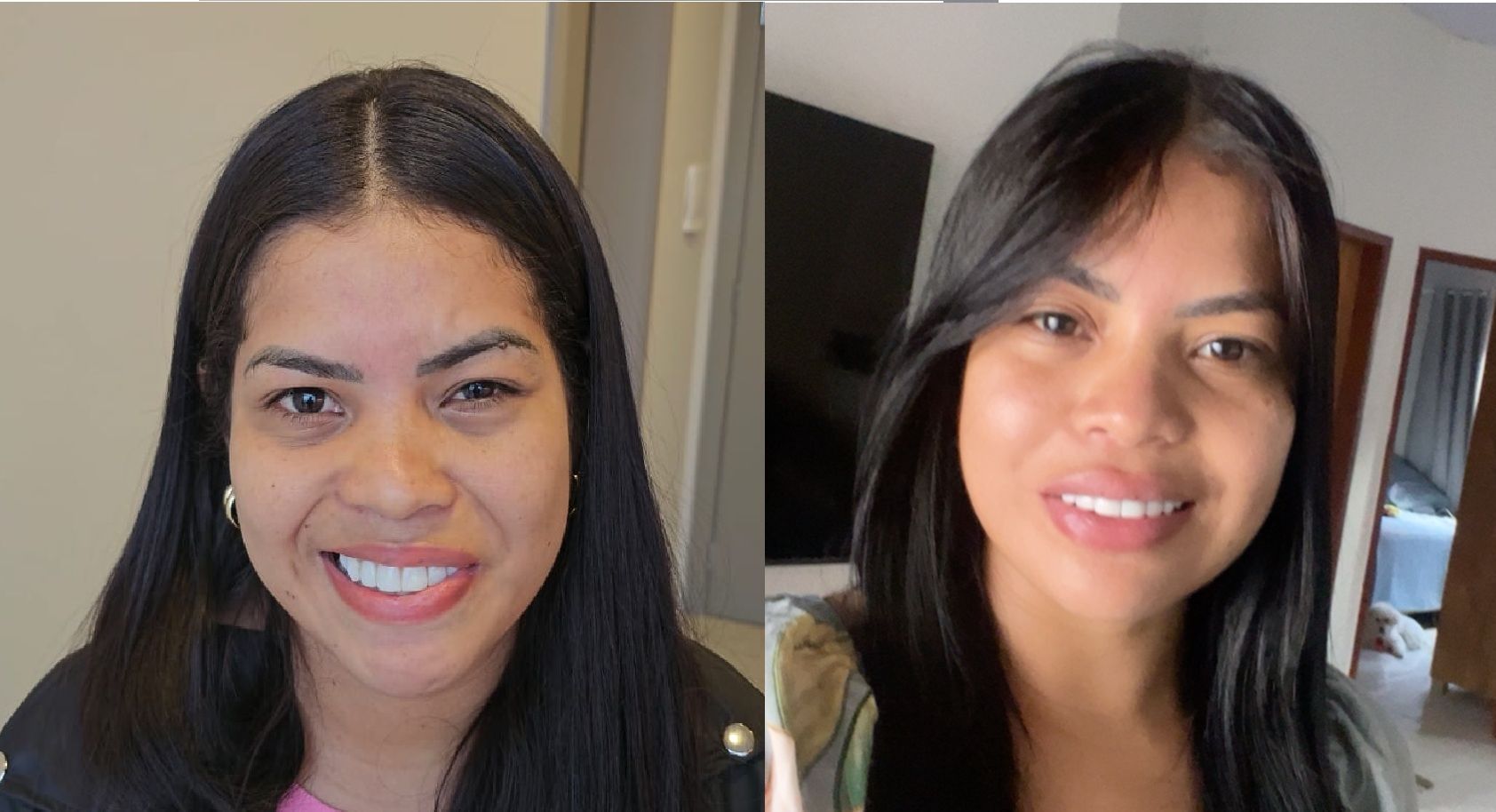 Sequelas de paralisia facial antes e depois: cirurgia de miectomia e neurectomia para sincinesia