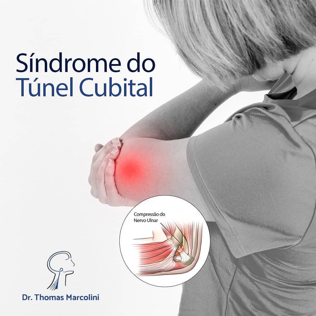 Dr. Thomas Marcolini explica a síndrome do túnel cubital, mulher sentindo choque do cotovelo ao dedinho pelo nervo ulnar
