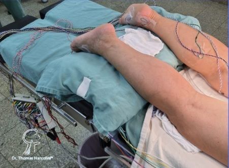 Neuromonitorização intraoperatória em cirurgia de Drezotomia, garantindo segurança na manipulação da medula espinhal.