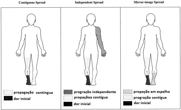 Ilustração de três padrões de propagação da dor complexa regional pelo corpo: contígua, independente e em espelho