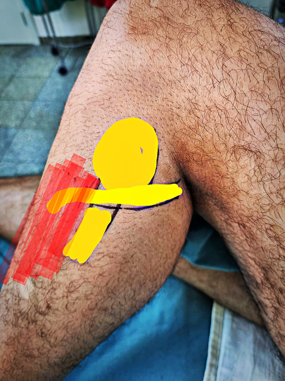 Joelho marcado no trajeto do nervo fibular, ponto de compressão que causa pé caído