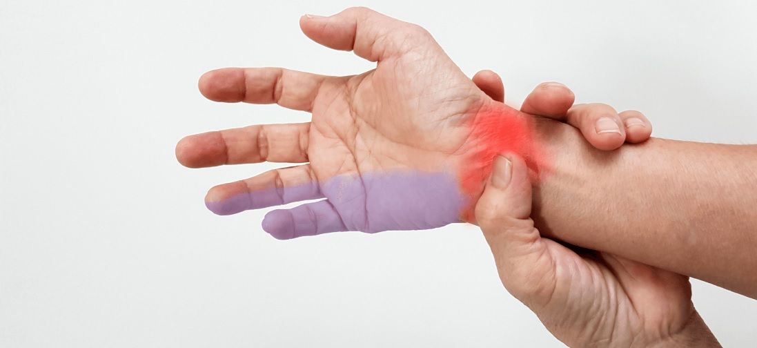 Mão com dedo mínimo e anelar destacados em roxo e punho em vermelho, área de formigamento da neuropatia do nervo ulnar