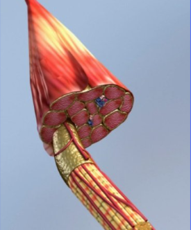 Eletroneuromiografia para schwannoma de nervo periférico