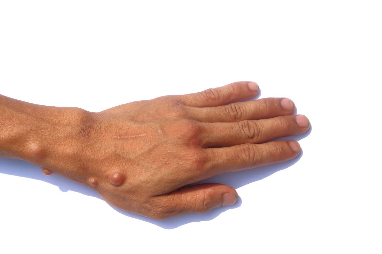 Médico para neurofibroma em SP capital. Médico para neurofibroma em São paulo.