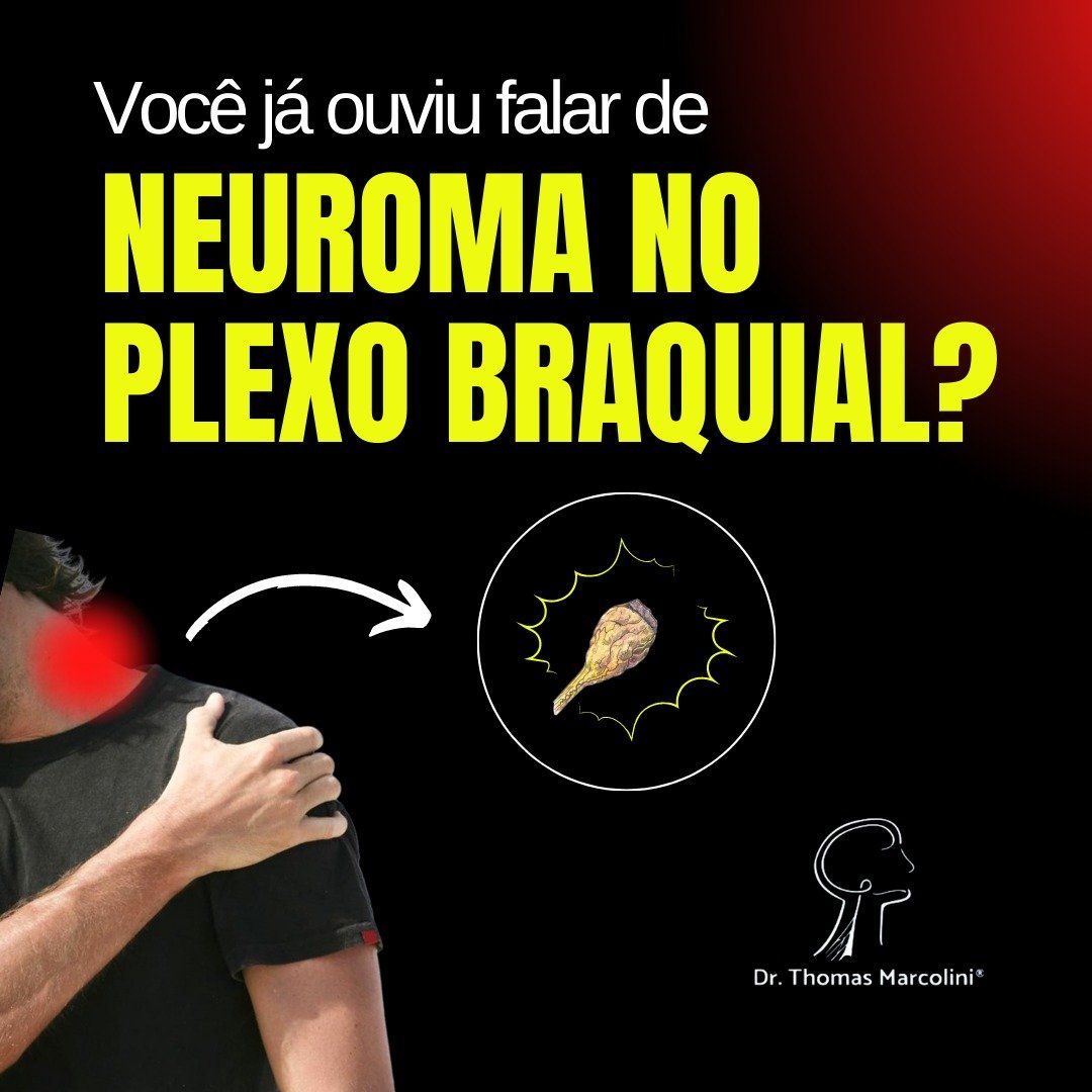 Neuroma de nervo o que é. Neuroma de plexo braquial.