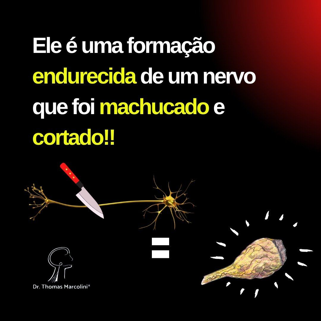 Como melhorar um neruoma? Como forma um neuroma.
