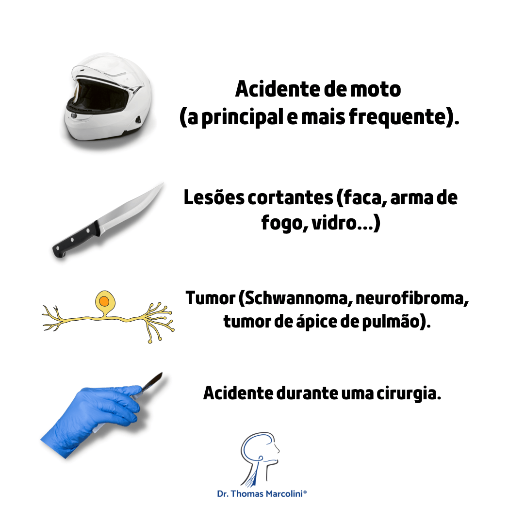 Infográfico com as causas da lesão do plexo braquial: acidente de moto, lesões cortantes, tumor e acidente cirúrgico