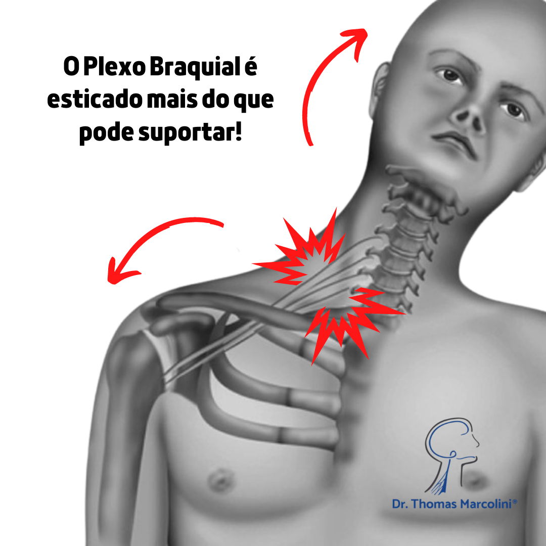Ilustração do pescoço e ombro com setas mostrando o estiramento excessivo do plexo braquial que causa a lesão dos nervos