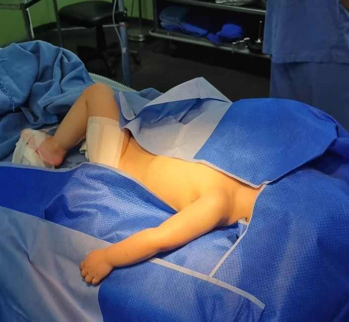 Diagnóstico de lesão de plexo braquial em bebês
