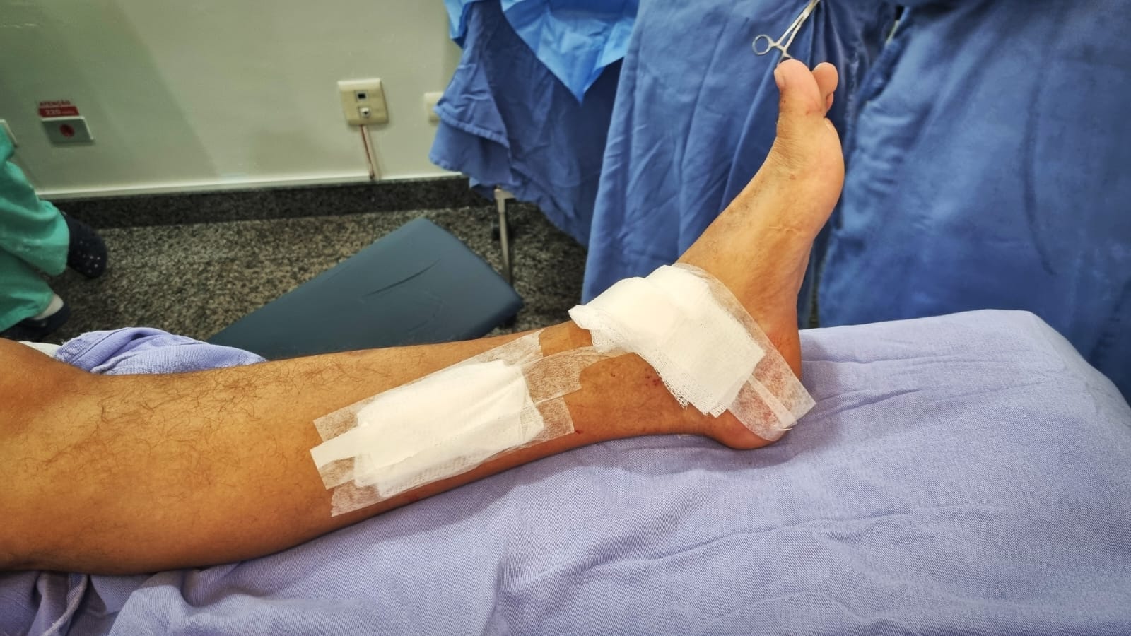 Pé em pós-operatório com curativo, cirurgia ajuda a melhorar o passo no pé caído