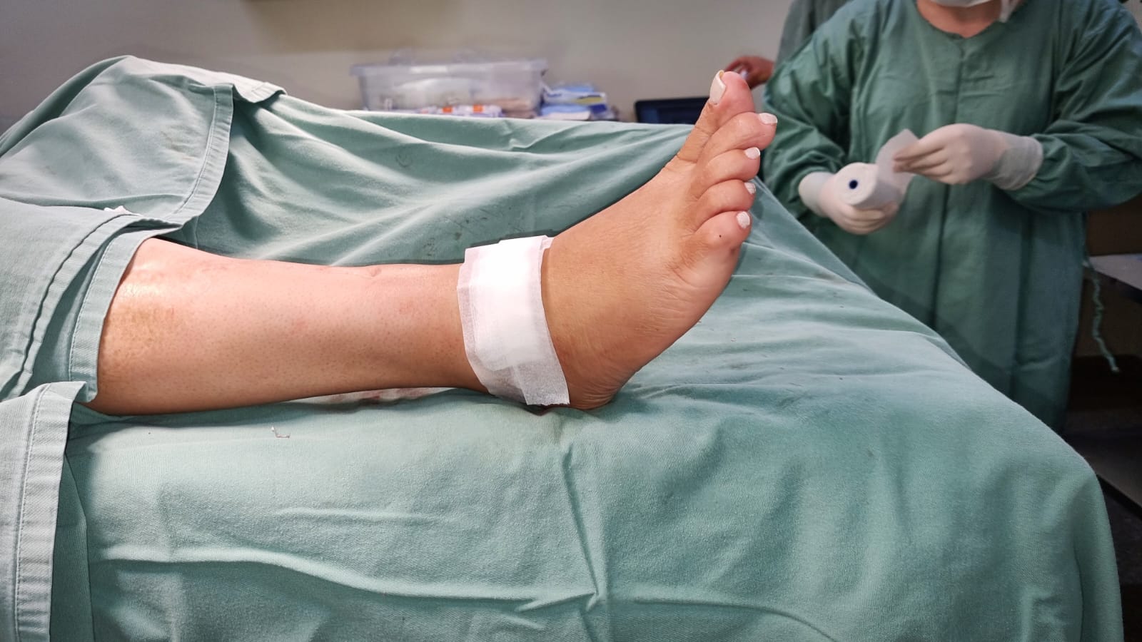 Estimulador de nervo aplicado no pé após cirurgia de pé caído, tratamento de nervo periférico