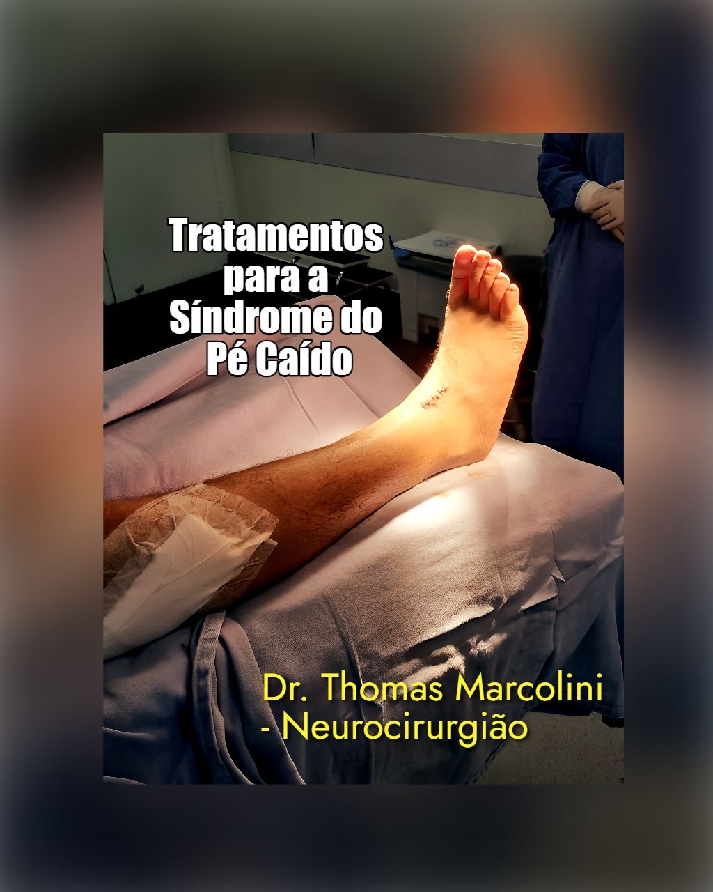 Pé de paciente em leito hospitalar, tratamentos do Dr. Thomas Marcolini para síndrome do pé caído