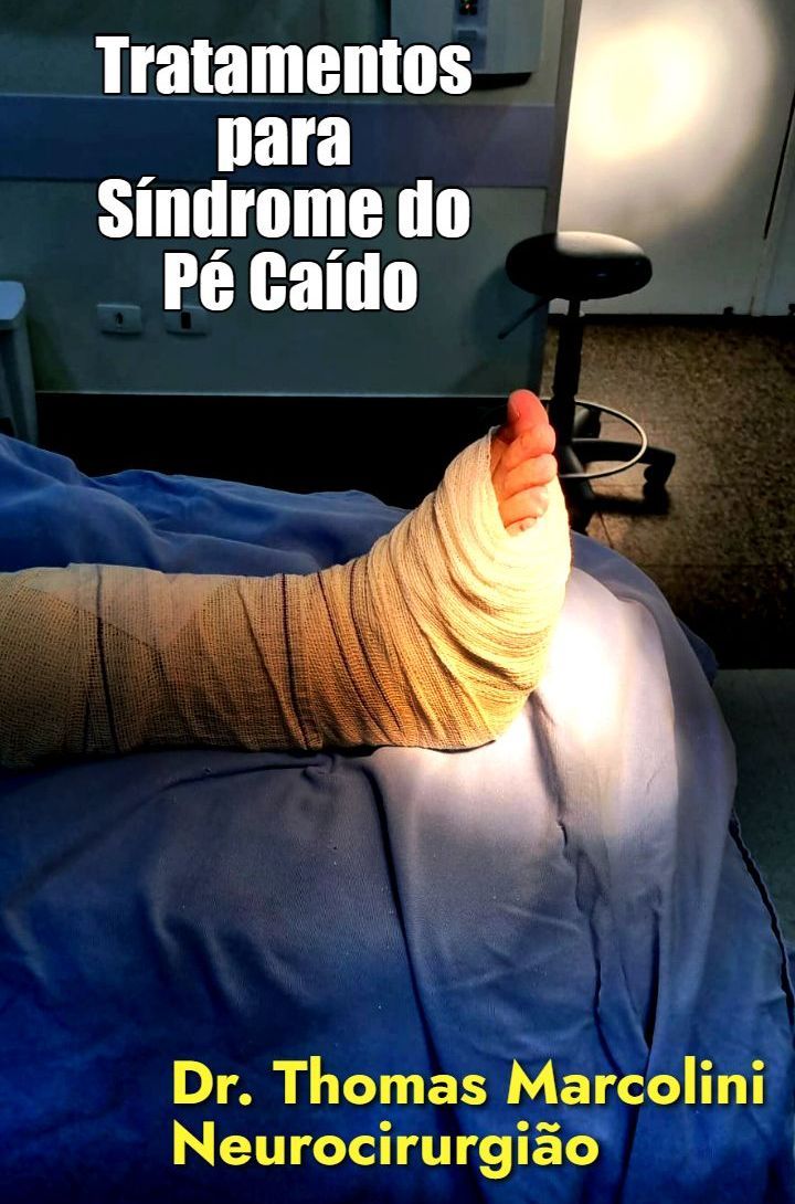 Pé enfaixado em leito hospitalar após tratamento cirúrgico da síndrome do pé caído
