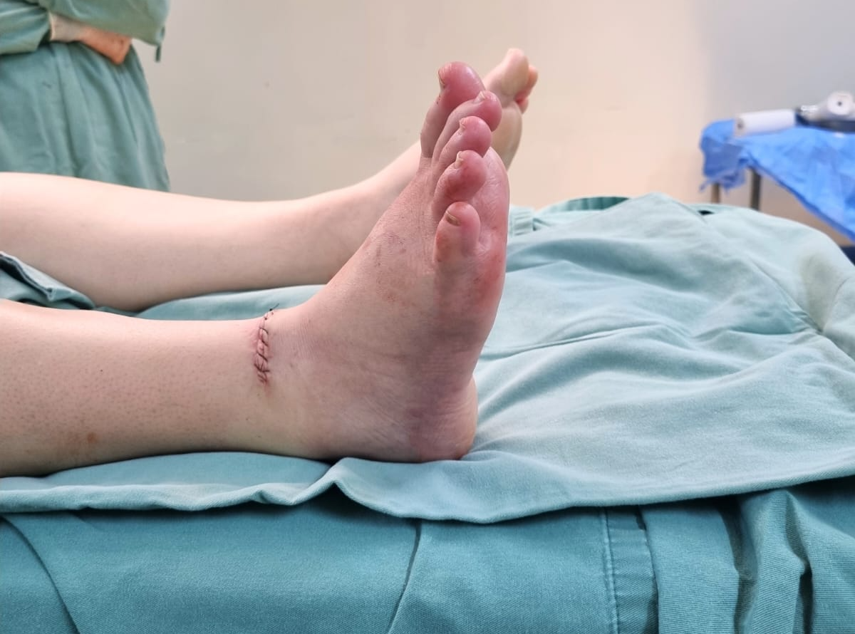 Recuperação da cirurgia do pé caído