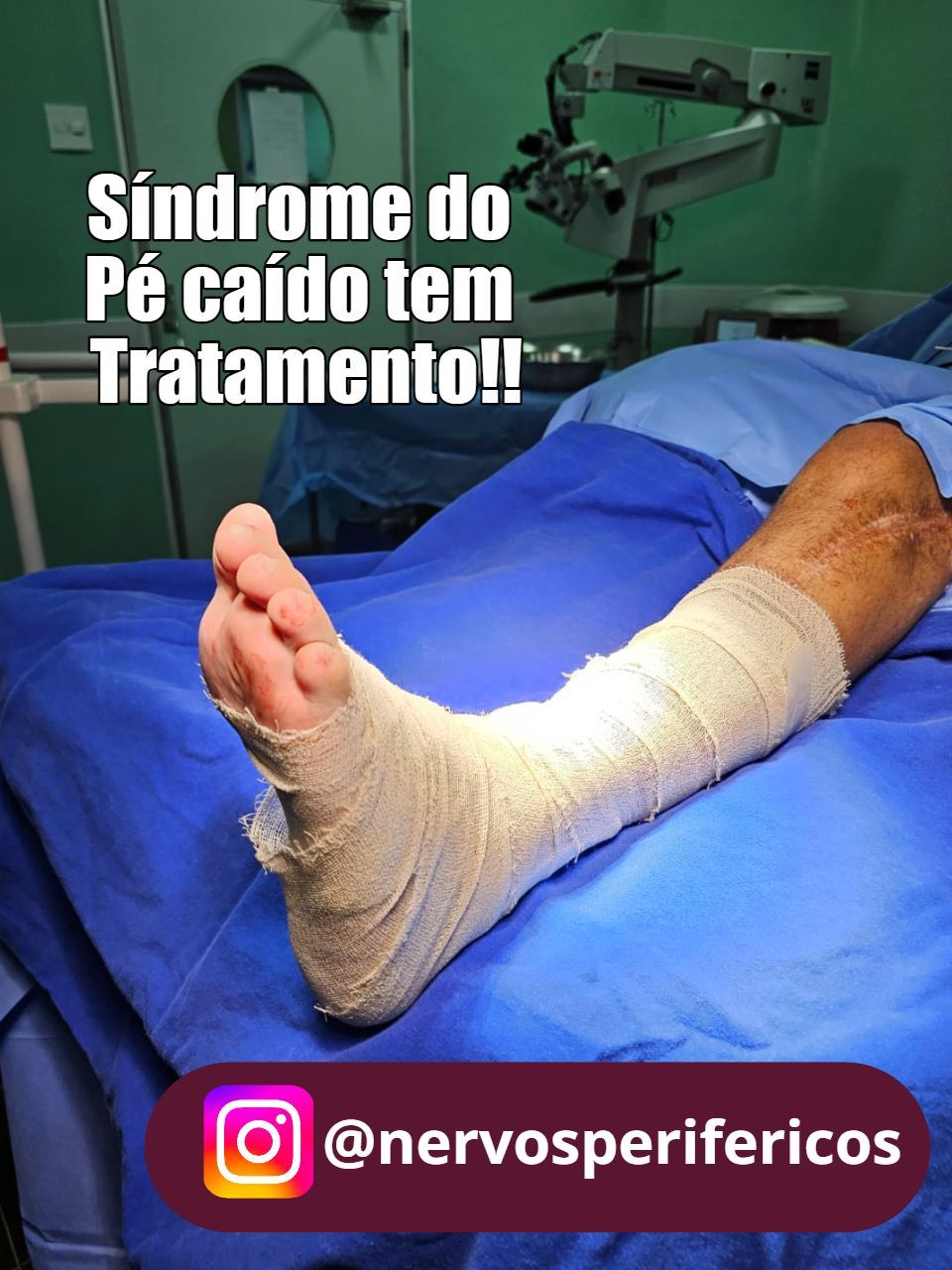 Pé enfaixado após cirurgia para tratamento da síndrome do pé caído
