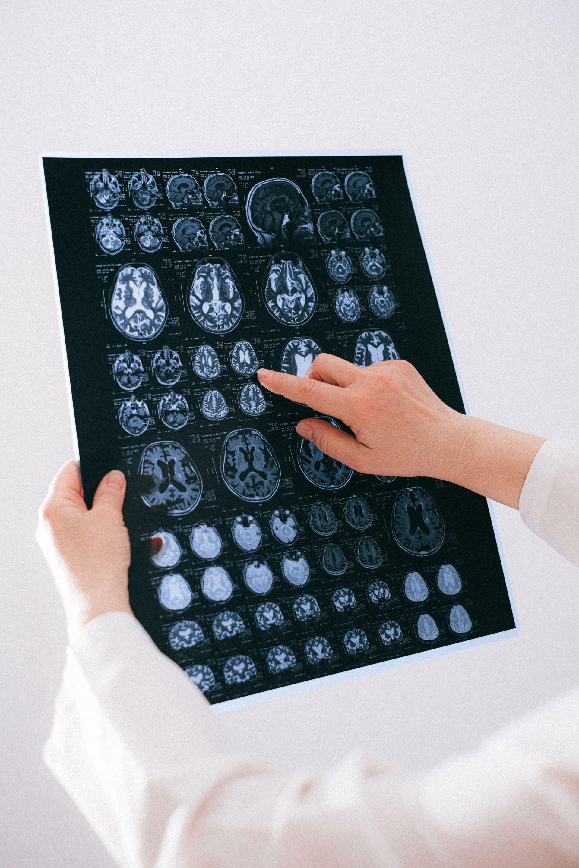 Ressonância magnética usada no diagnóstico de tumor da bainha do nervo, schwannoma e neurofibroma