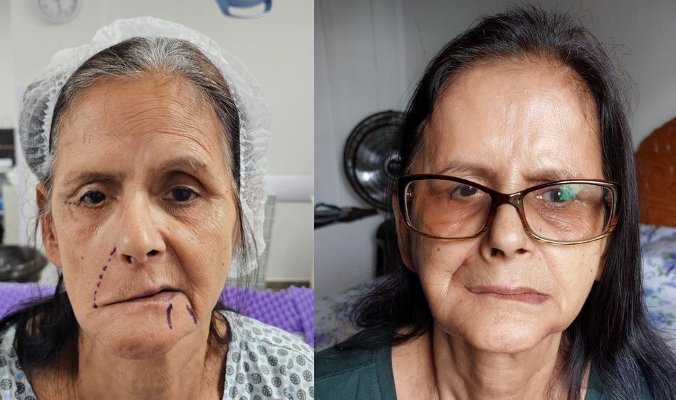 Como é o diagnóstico da paralisia facial em são paulo?