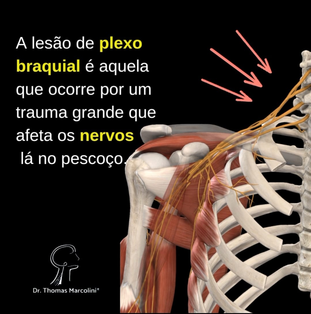 Ilustração anatômica dos nervos do ombro e pescoço, explicando que a lesão do plexo braquial ocorre por trauma grande que afeta os nervos
