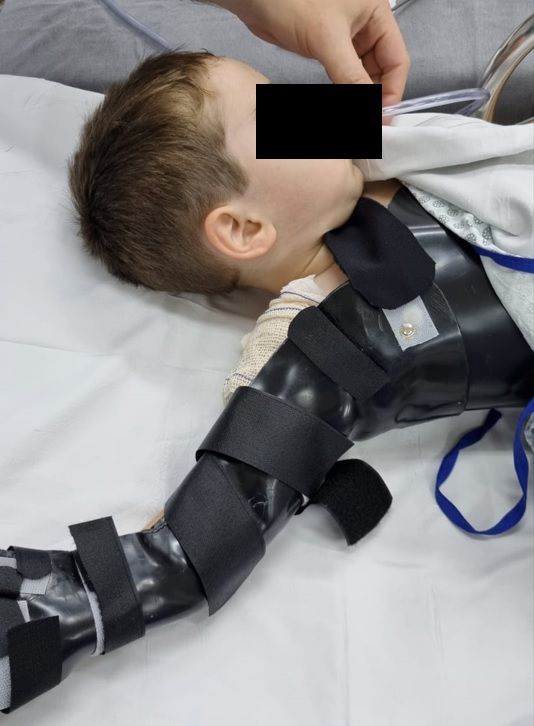 Bebê operado de plexo braquial obstétrico.