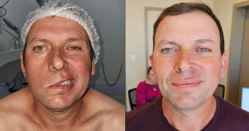 Diagnóstico oda paralisia facial em são paulo.