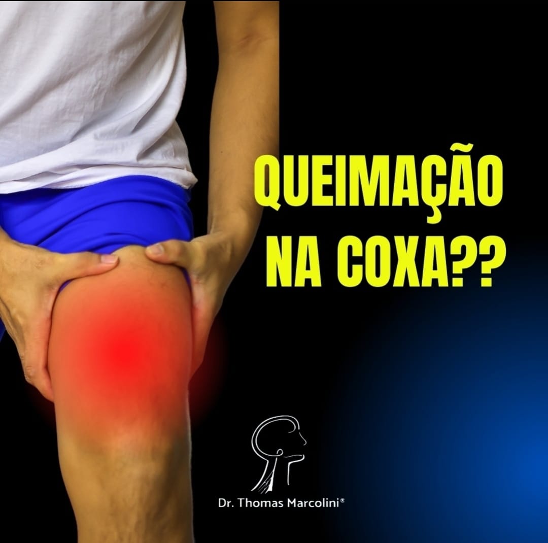 Queimação na coxa direita. Queimação na coxa esquerda.