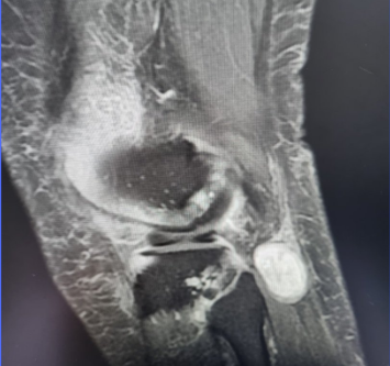 Ressonância magnética para schwannoma.