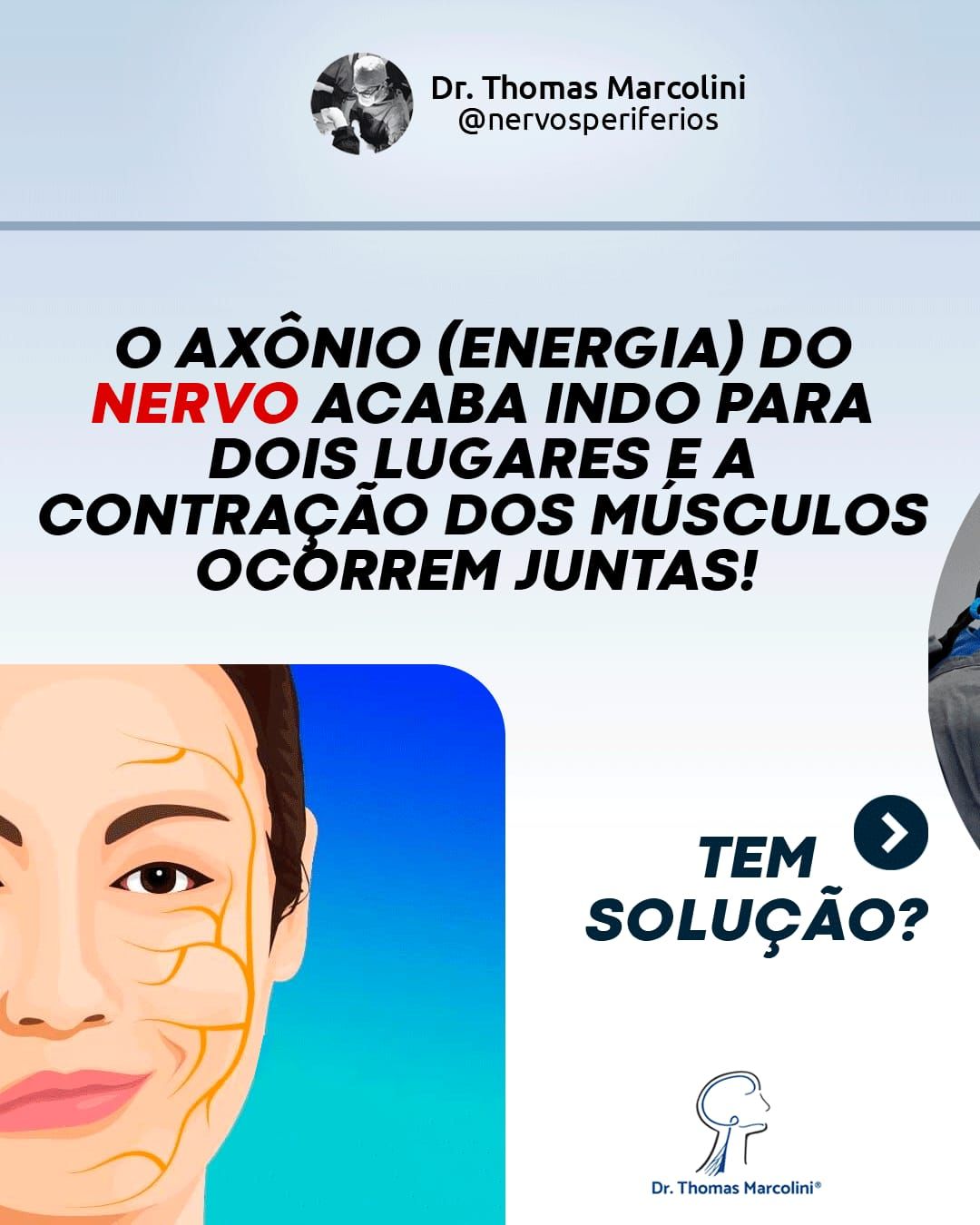 Dr. Thomas Marcolini explica por que o axônio do nervo causa contração conjunta dos músculos na sincinesia