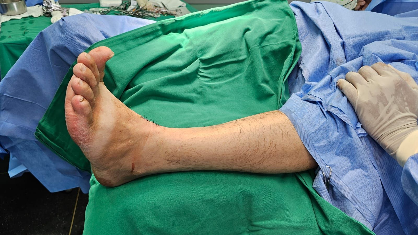 Cirurgia para Síndrome do pé caído.