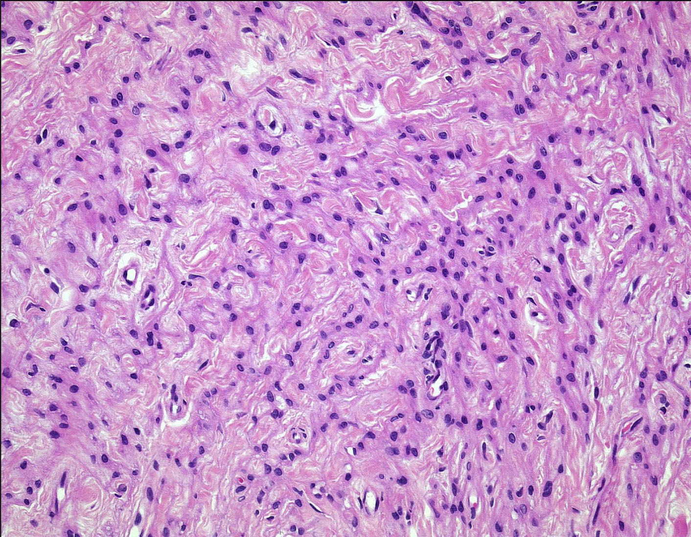 Especialista em schwannoma de nervos periféricos Especialista em tumores da bainha dos nervos periféricos em São paulo.