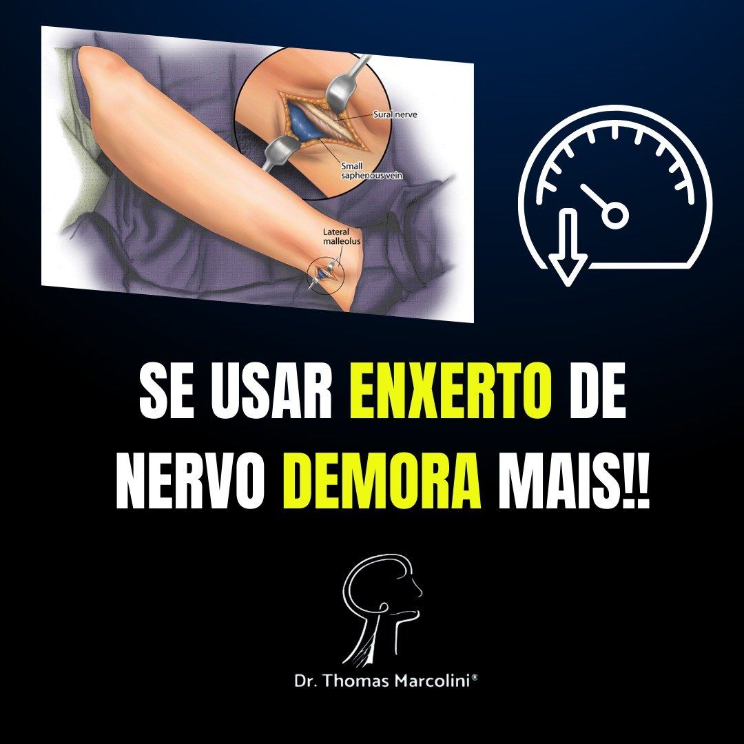 Enxerto de um nervo demora mais tempo para recuperar. Tempo de recuperação após enxerto de um nervo.