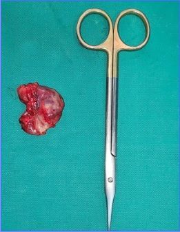 médico especialista em Neurofibroma de nervo