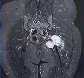Fator de risco para schwannoma de nervo periférico.