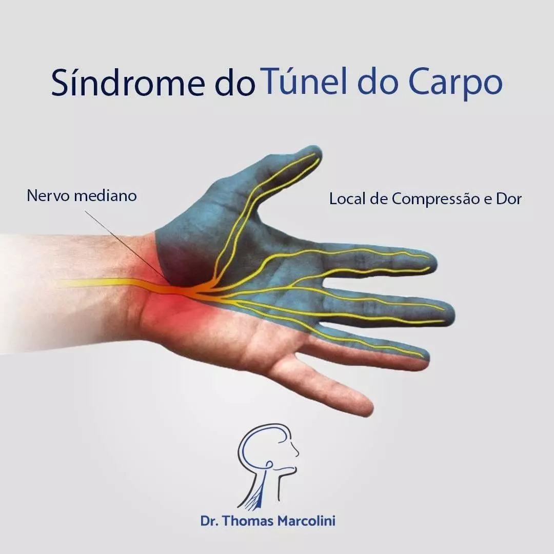 Médico Especialista em Síndrome do Túnel do Carpo em Curitiba médico Especialista em Síndrome do Túnel do Carpo em Curitiba