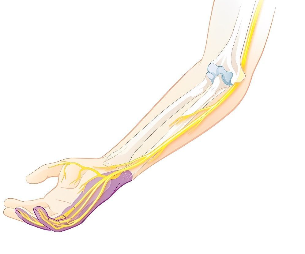 Ilustração anatômica do braço mostrando o trajeto do nervo ulnar e a área de sensibilidade na mão em roxo
