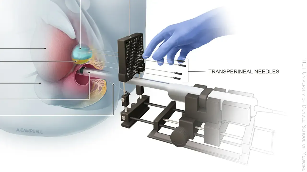 BPH Surgery Melbourne