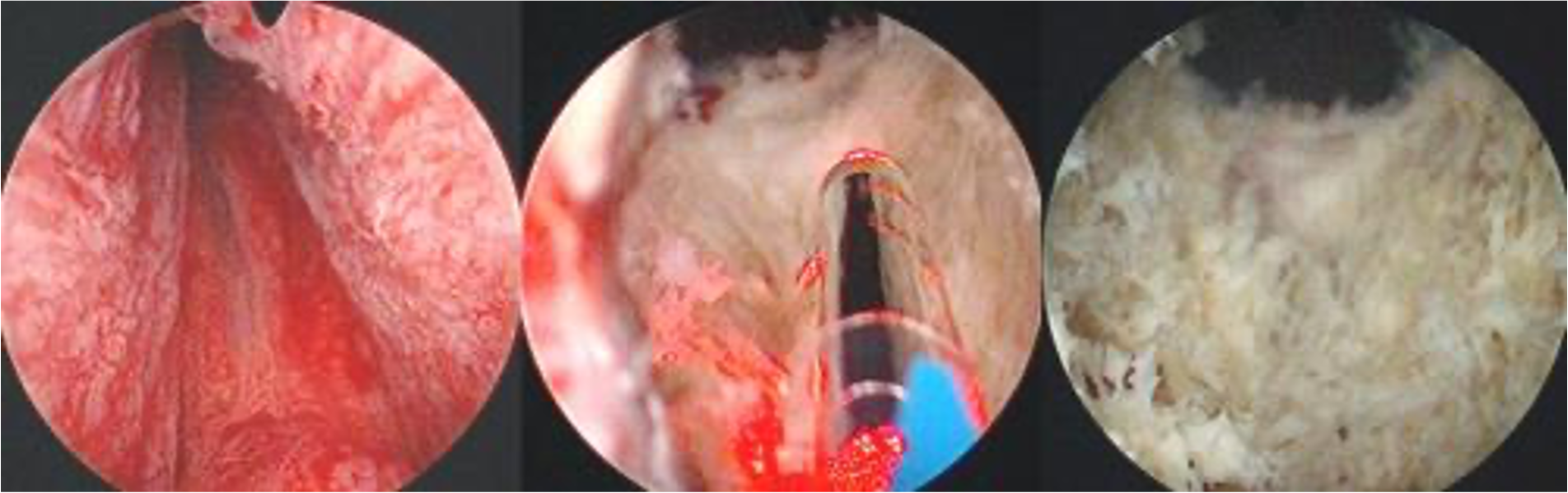 BPH Treatment How surgery works
