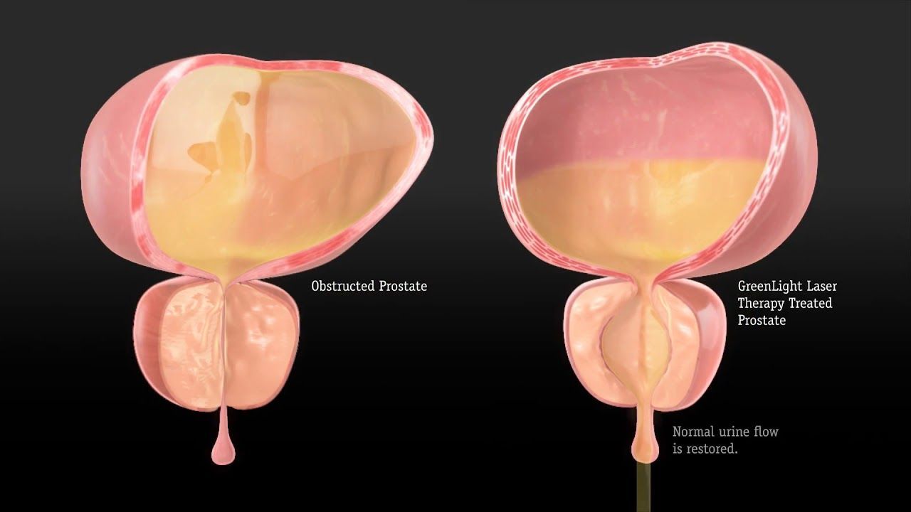 Greenlight Laser - BPH Treatment How it works