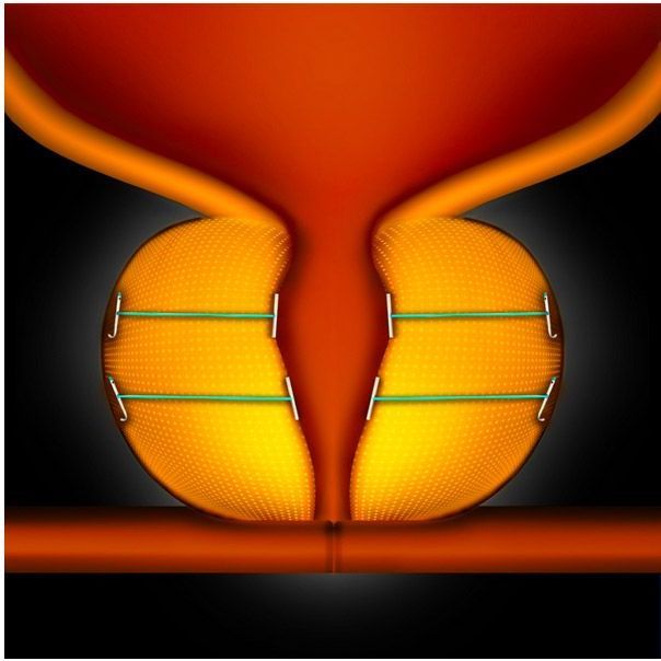 Urolift - BPH Treatment How it works