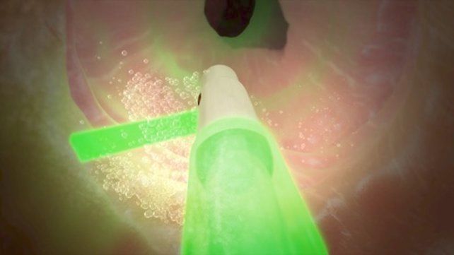 BPH Treatment How it works
