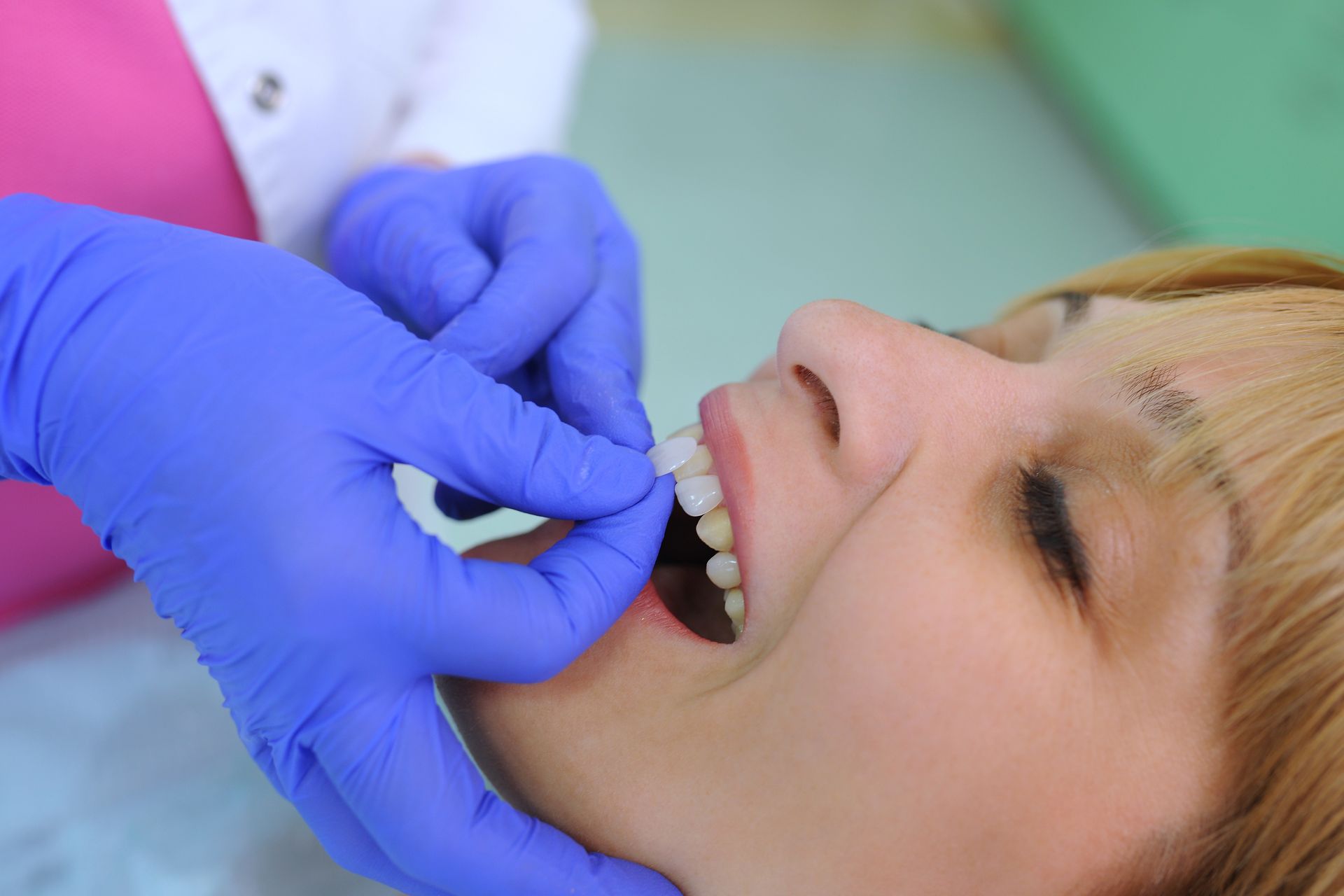 Dentist puts dental veneers for correction of patient's teeth.