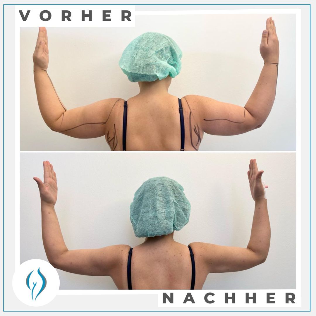 Luxus Entwssern Nach Liposuktion Bild